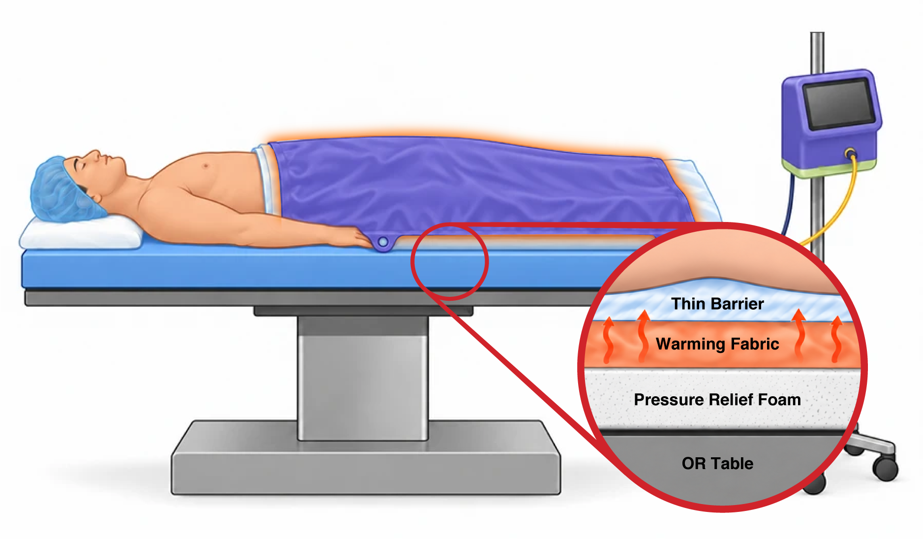 HotDog conductive warming system warming a supine patient from above and below, with a cutaway showing the underbody warming mattress layers.